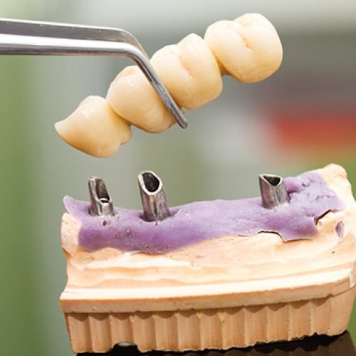 Dental-Bridges